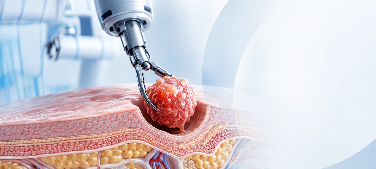 Tumor Surgery