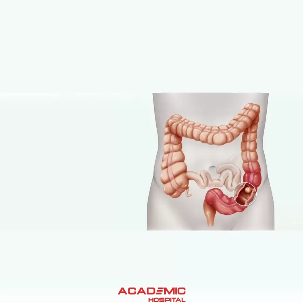 Colorectal Cancer Epidemics and Risk Factors