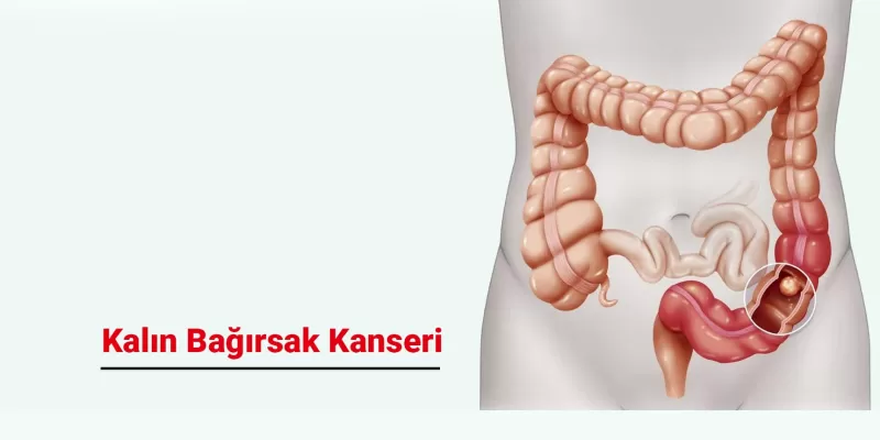 Kalın Bağırsak Kanseri Belirtileri ve Risk Faktörleri