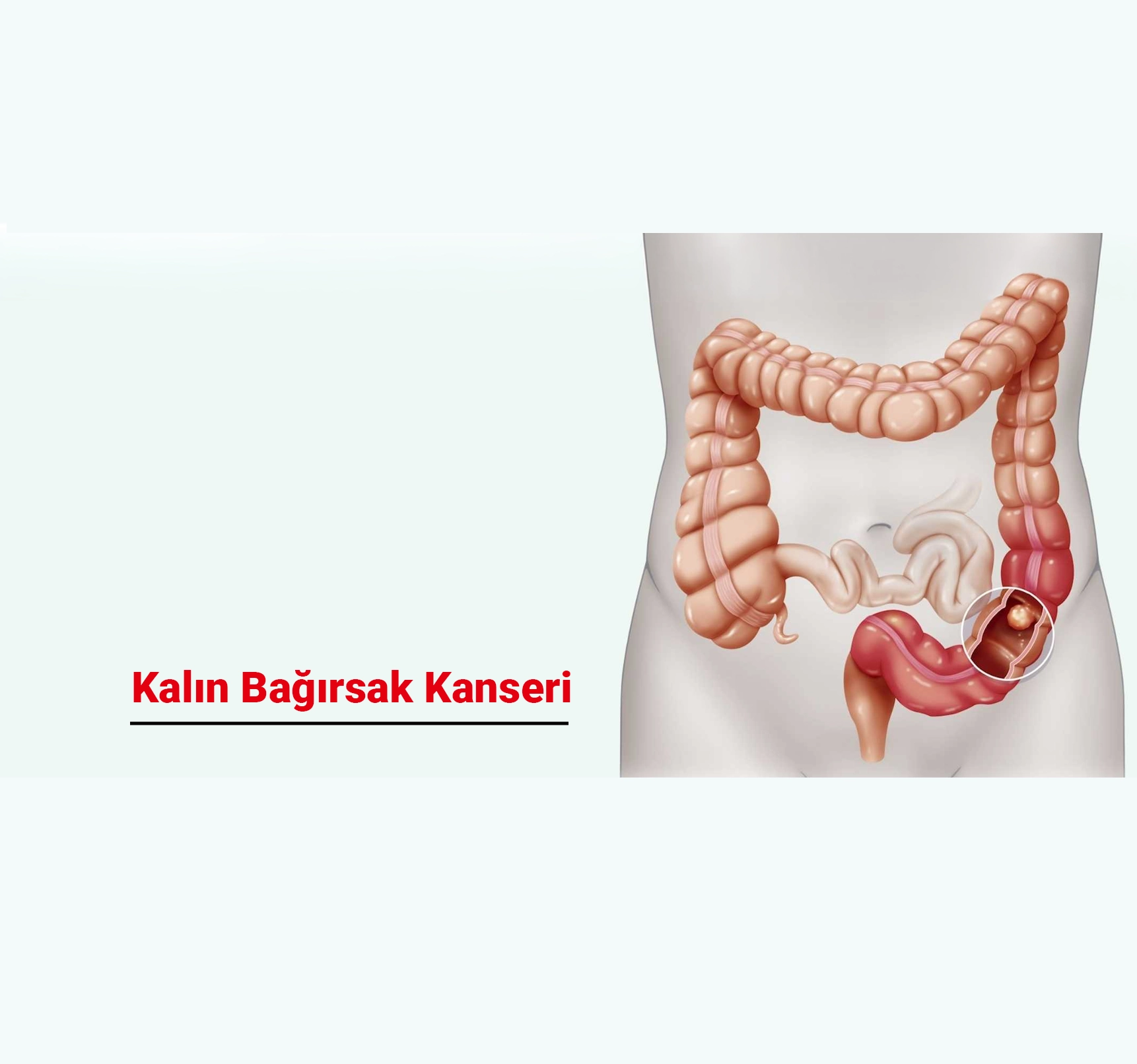 Kalın Bağırsak Kanseri Belirtileri ve Risk Faktörleri