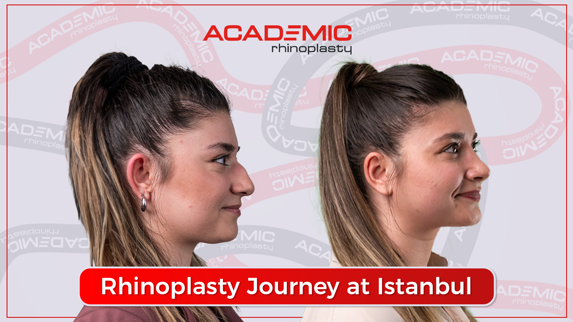 Ms. Ece Shares Her Rhinoplasty Surgery Experience!