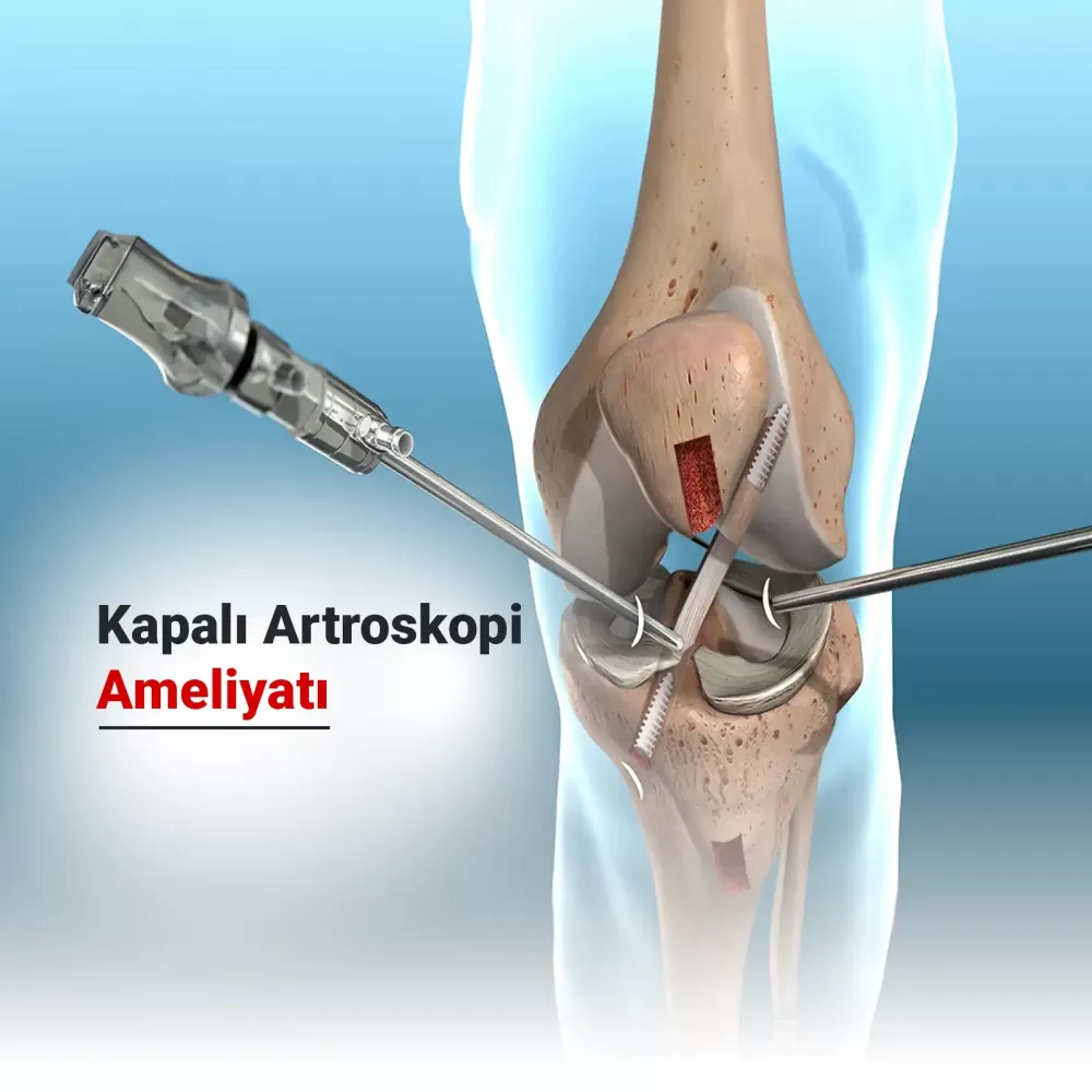Kapalı Artroskopi Ameliyatı Nedir? Nasıl Yapılır? Neden Uygulanır?