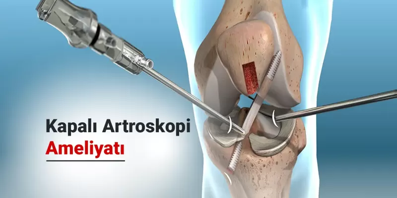 Kapalı Artroskopi Ameliyatı Nedir? Nasıl Yapılır? Neden Uygulanır?