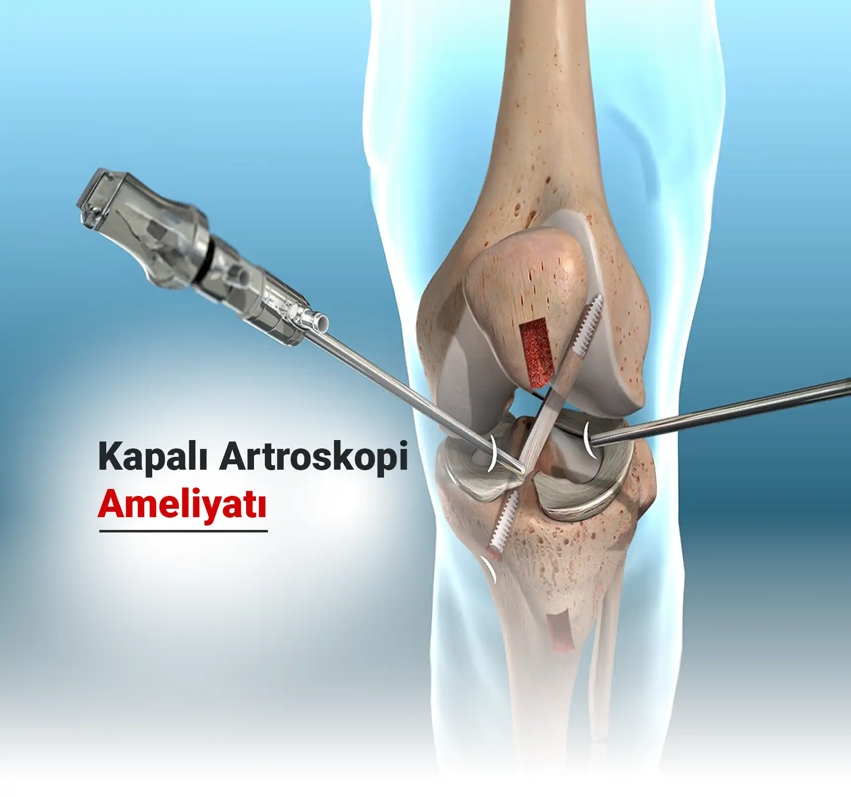 Kapalı Artroskopi Ameliyatı Nedir? Nasıl Yapılır? Neden Uygulanır?
