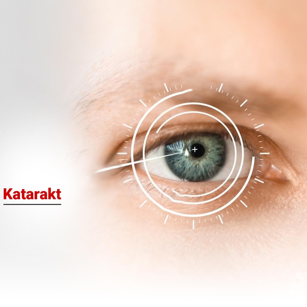 Katarakt Nedir? Belirtileri, Nedenleri ve Tedavi Yöntemleri