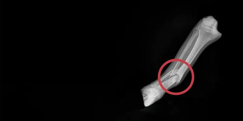 Kemiğin Kaynamaması (Nonunion) Neden Olur? Kemiğin Kaynamadığını Nasıl Anlarız?
