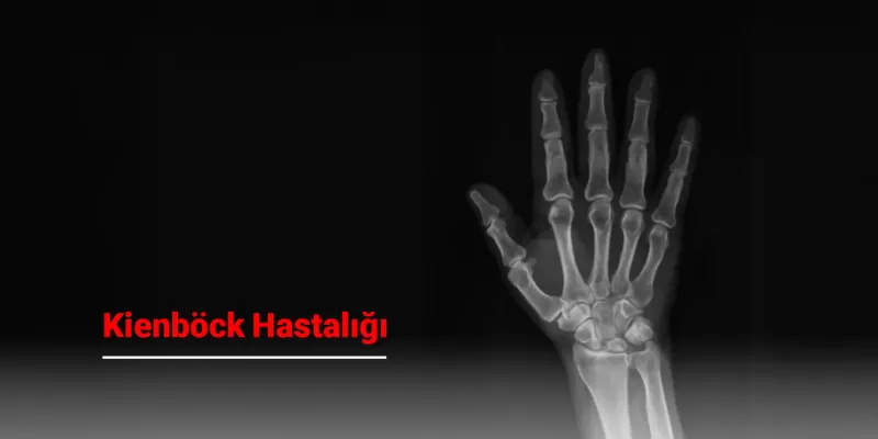 Kienböck Hastalığı Nedir? Belirtileri, Tanı ve Tedavi Yöntemleri