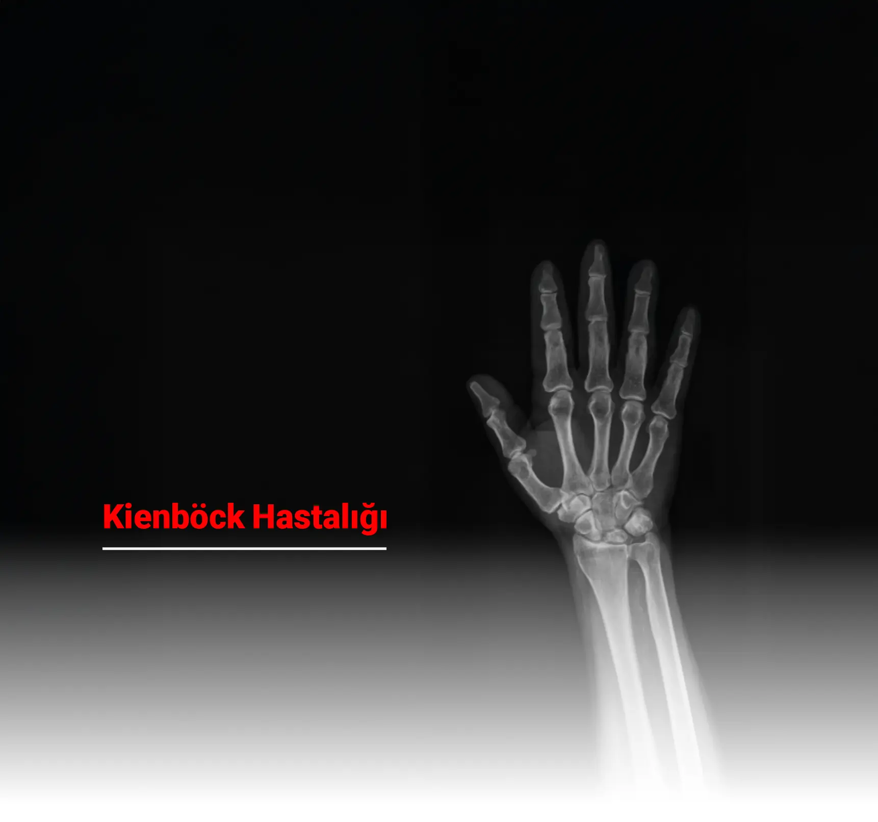 Kienböck Hastalığı Nedir? Belirtileri, Tanı ve Tedavi Yöntemleri