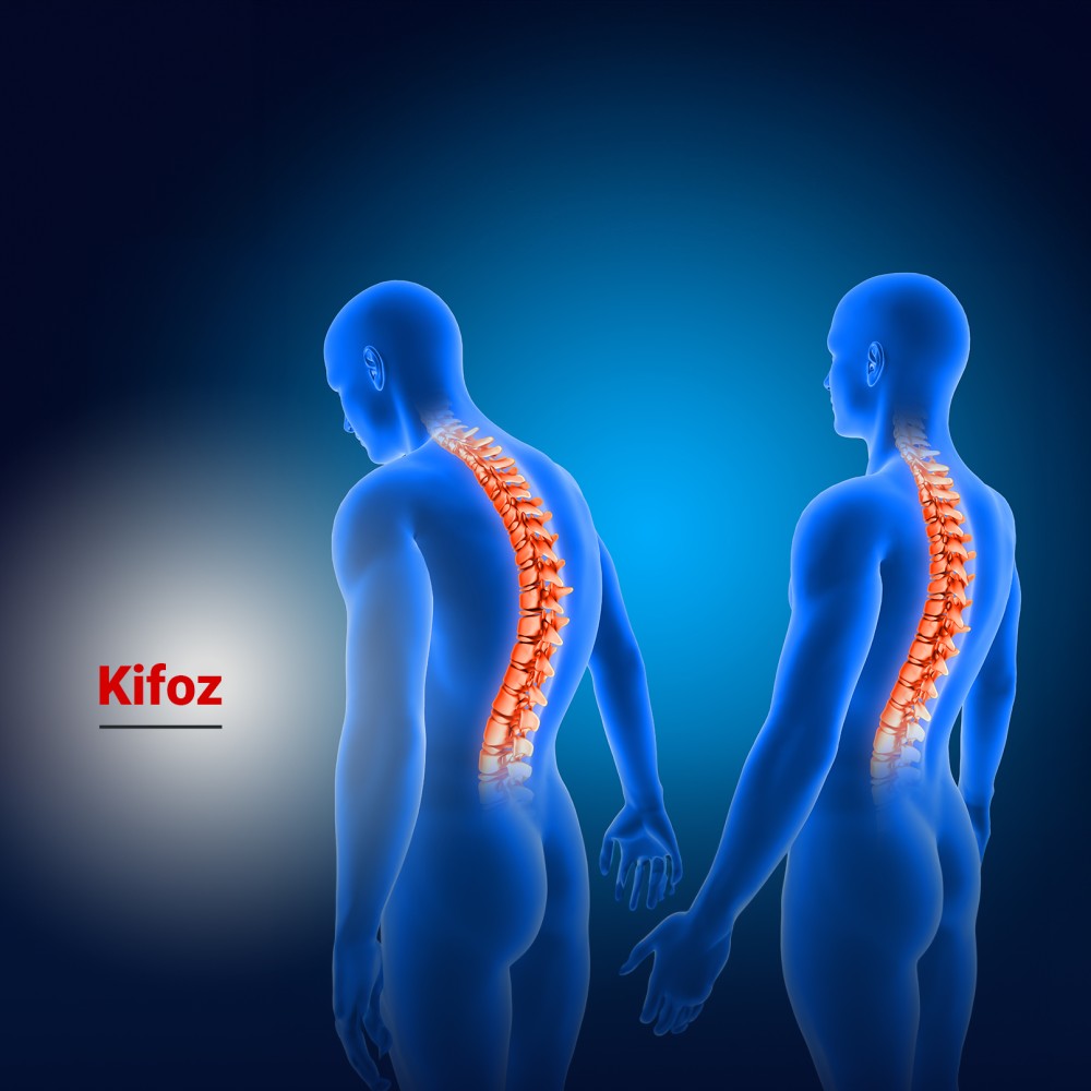 Kifoz Nedir? Belirtileri ve Tedavi Yöntemleri Nelerdir?
