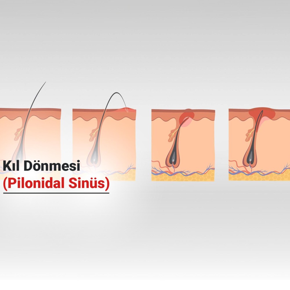 Kıl Dönmesi (Pilonidal Sinüs) Nedir?