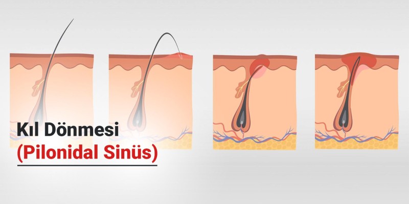 Kıl Dönmesi (Pilonidal Sinüs) Nedir?