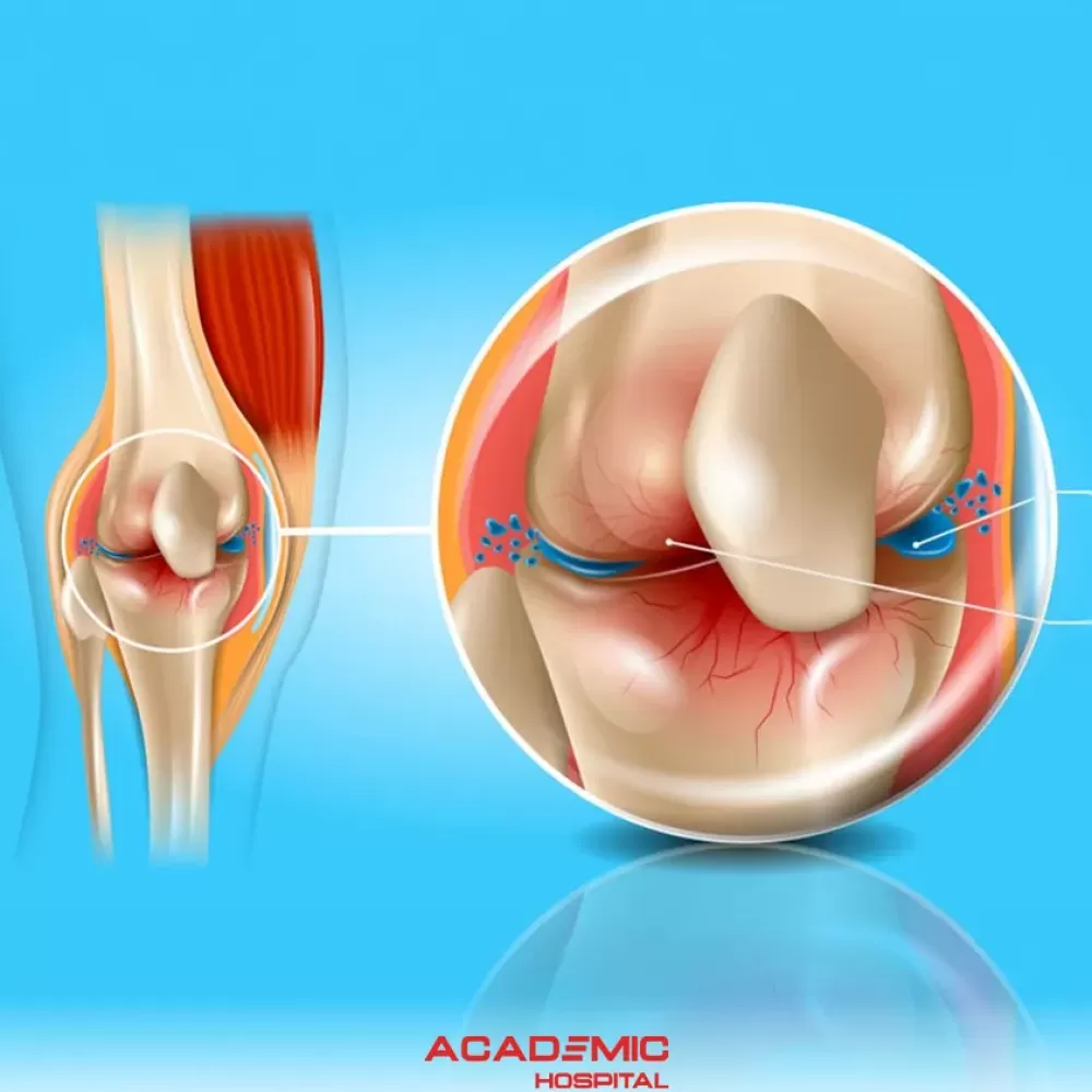 Kireçlenme (Osteoartrit ) Nedir? Belirtileri ve Tedavi Yöntemleri Nelerdir?