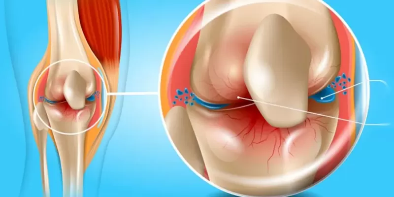  What Is Osteoarthritis? What Are Its Symptoms and Treatment Methods?