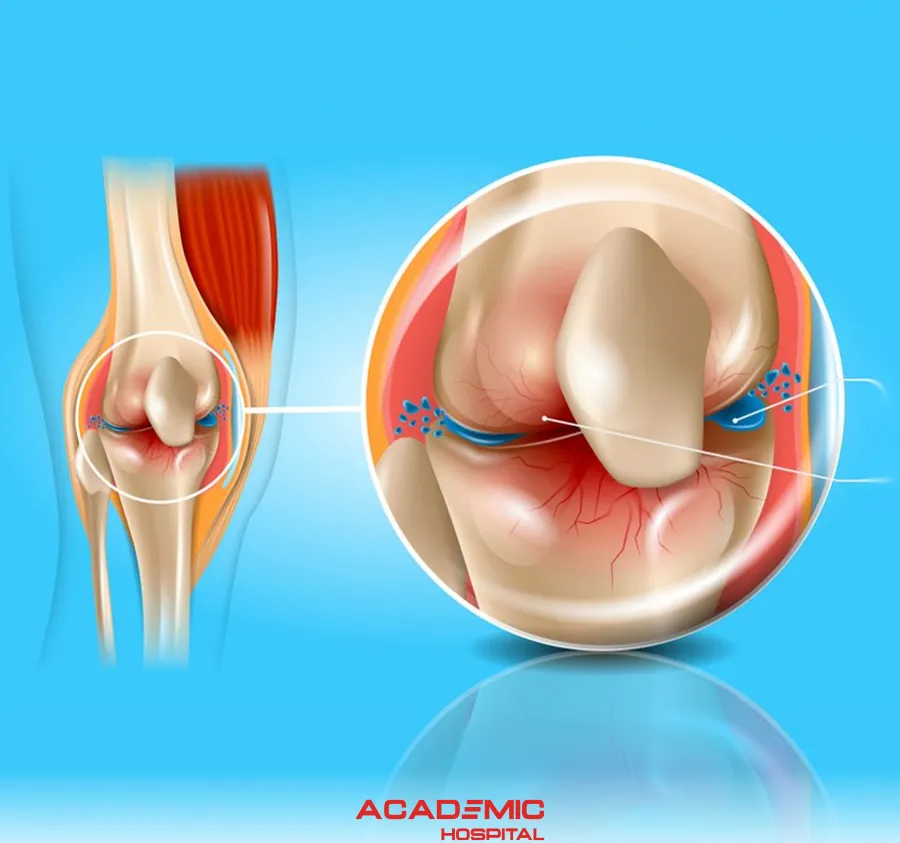  What Is Osteoarthritis? What Are Its Symptoms and Treatment Methods?