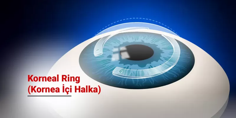 Korneal Ring (Kornea İçi Halka) Nedir? Kimler İçin Uygundur?