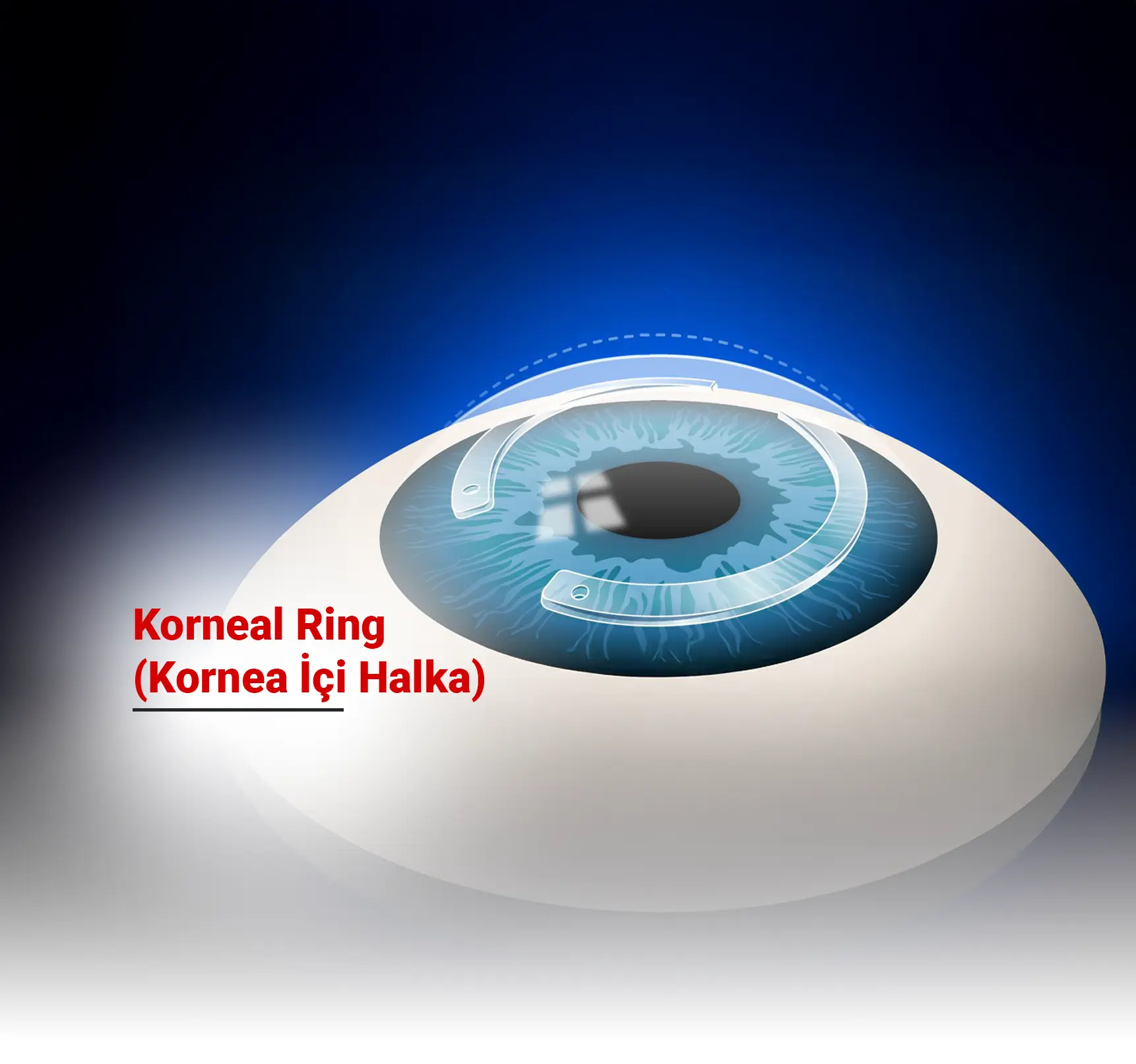 Korneal Ring (Kornea İçi Halka) Nedir? Kimler İçin Uygundur?
