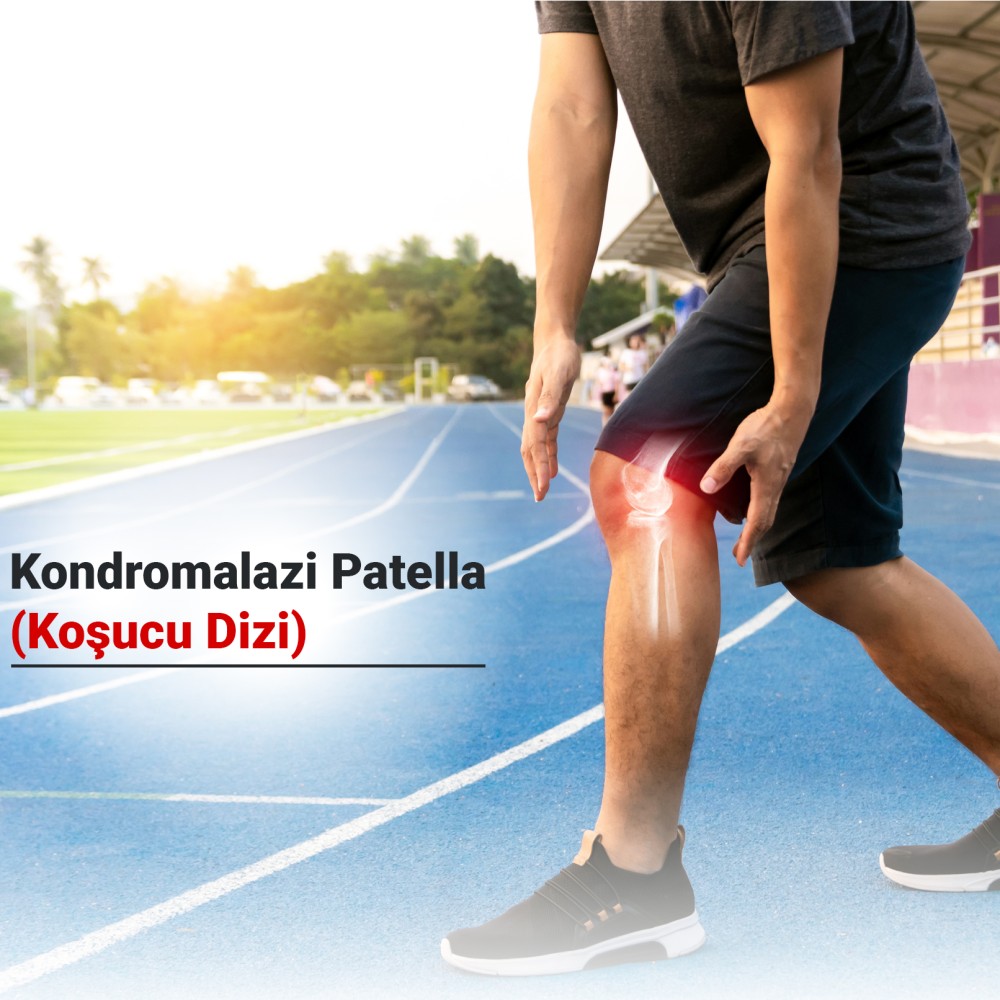 Kondromalazi Patella (Koşucu Dizi) Nedir? Belirtileri, Nedenleri ve Tedavi Yöntemleri