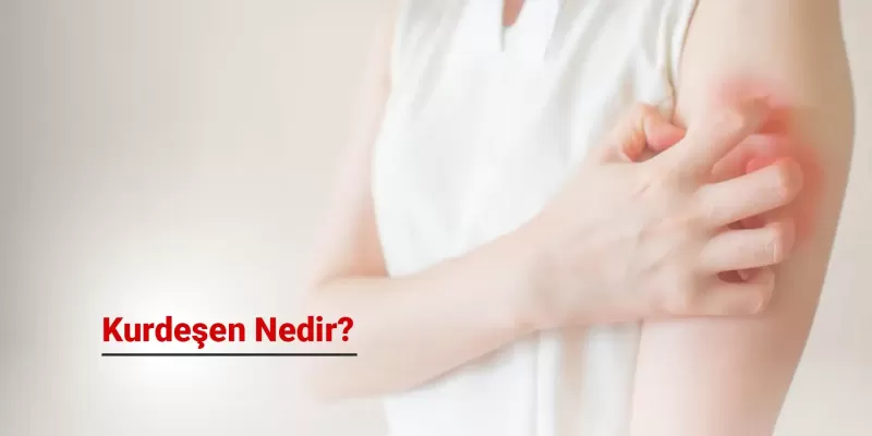 Kurdeşen Nedir?