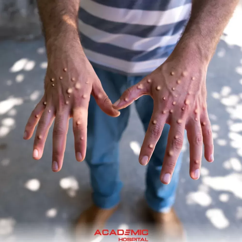 Maymun Çiçeği Hastalığı (Monkeypox) Nasıl Bulaşır? Aşısı ve Tedavi Yöntemleri