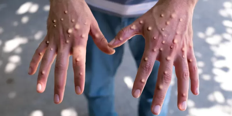 Maymun Çiçeği Hastalığı (Monkeypox) Nasıl Bulaşır? Aşısı ve Tedavi Yöntemleri
