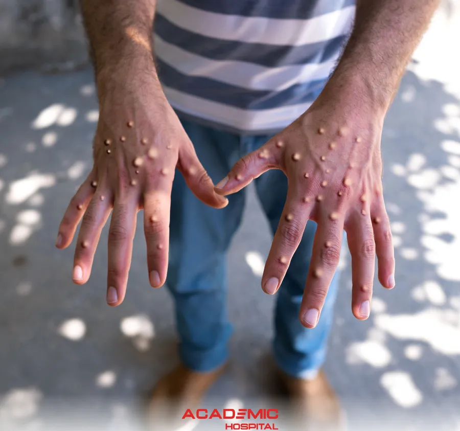 Maymun Çiçeği Hastalığı (Monkeypox) Nasıl Bulaşır? Aşısı ve Tedavi Yöntemleri
