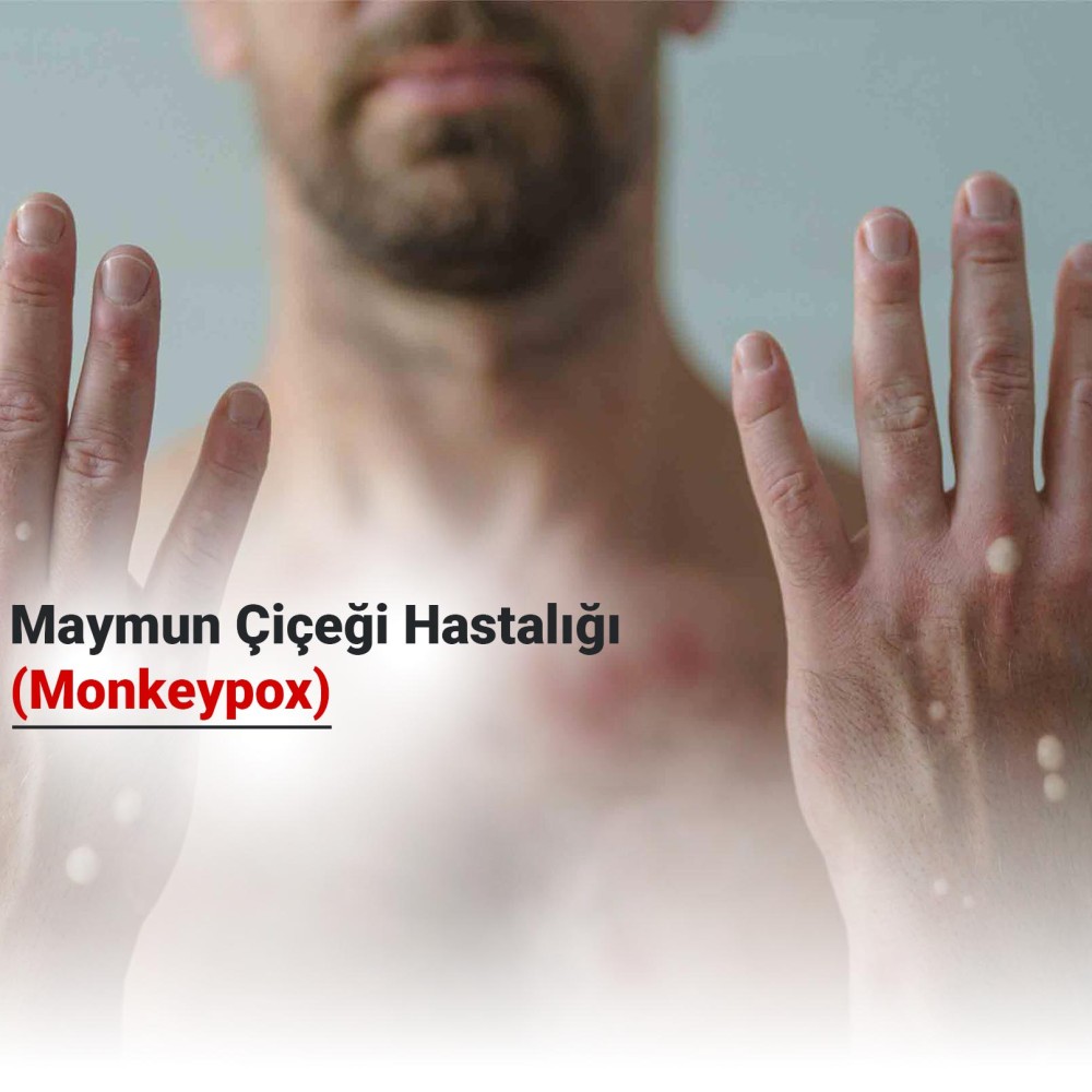 Maymun Çiçeği Hastalığı (Monkeypox) Nasıl Bulaşır? Aşısı ve Tedavi Yöntemleri