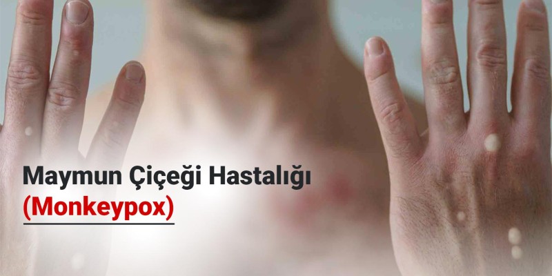 Maymun Çiçeği Hastalığı (Monkeypox) Nasıl Bulaşır? Aşısı ve Tedavi Yöntemleri