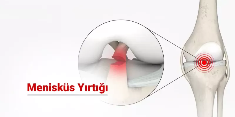 Menisküs Nedir? Menisküs Yırtığı Nedir? Tedavisi Nasıldır?
