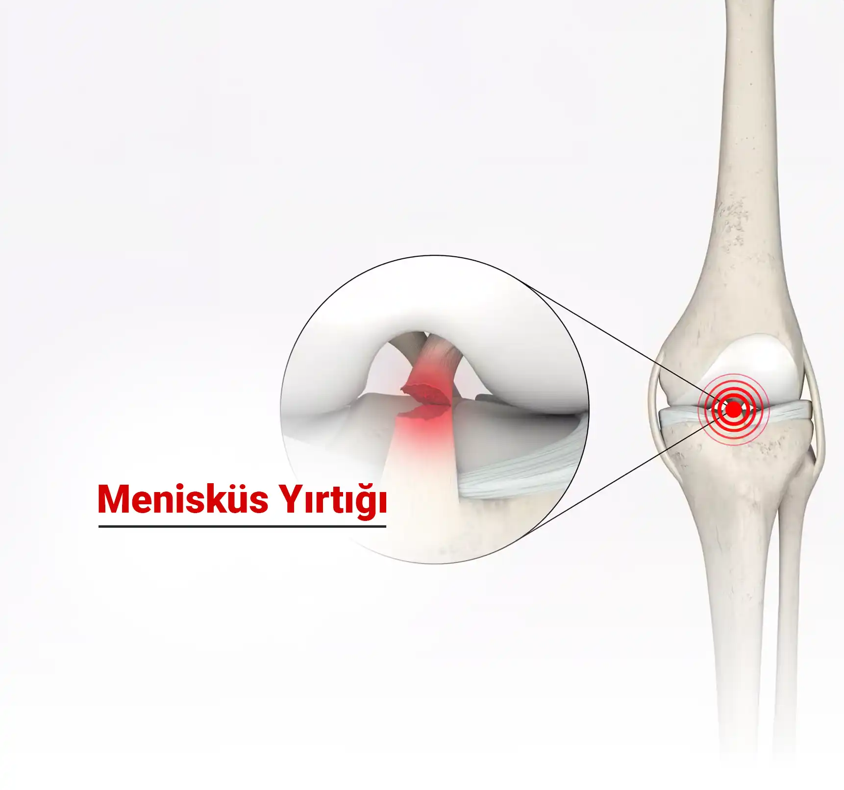 Menisküs Nedir? Menisküs Yırtığı Nedir? Tedavisi Nasıldır?