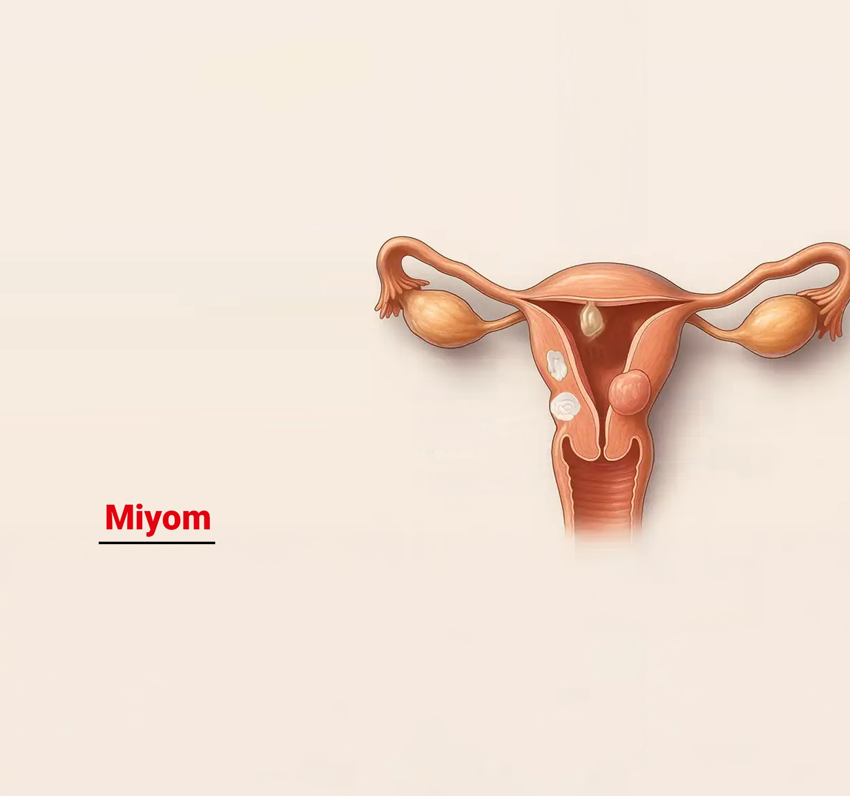 Miyom Nedir? Belirtileri, Nedenleri ve Tedavi Yöntemleri