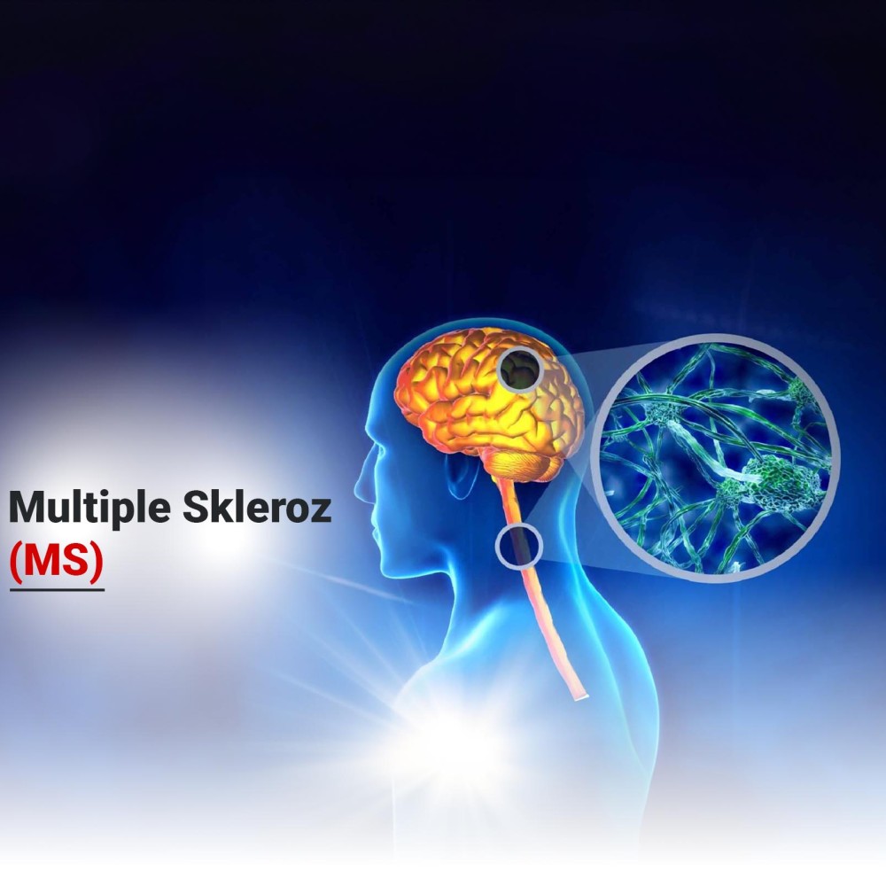 Merkezi Sinir Sistemini Etkileyen Hastalık: Multiple Skleroz (MS)