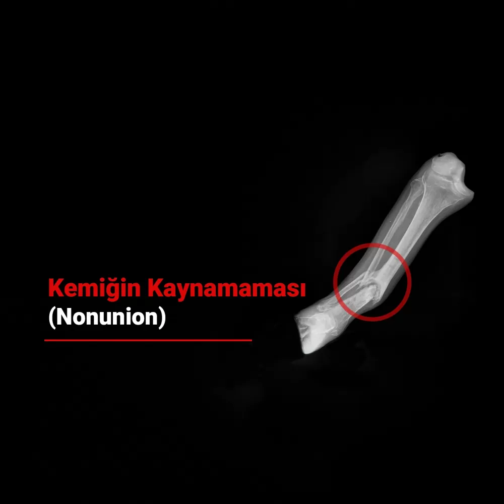 Kemiğin Kaynamaması (Nonunion) Neden Olur? Kemiğin Kaynamadığını Nasıl Anlarız?