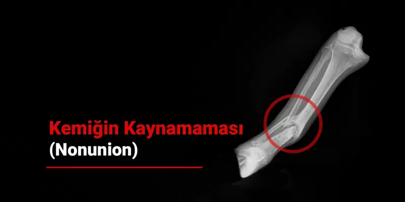 Kemiğin Kaynamaması (Nonunion) Neden Olur? Kemiğin Kaynamadığını Nasıl Anlarız?
