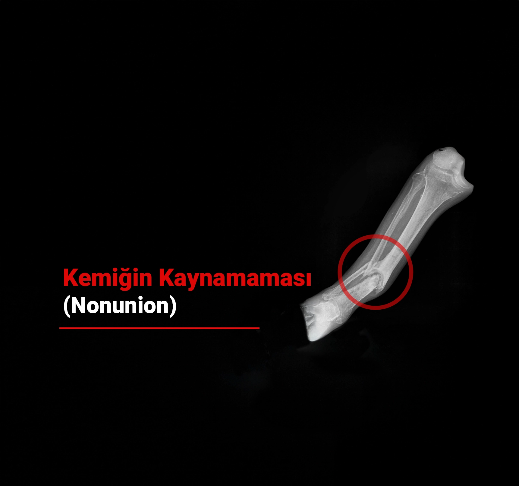 Kemiğin Kaynamaması (Nonunion) Neden Olur? Kemiğin Kaynamadığını Nasıl Anlarız?