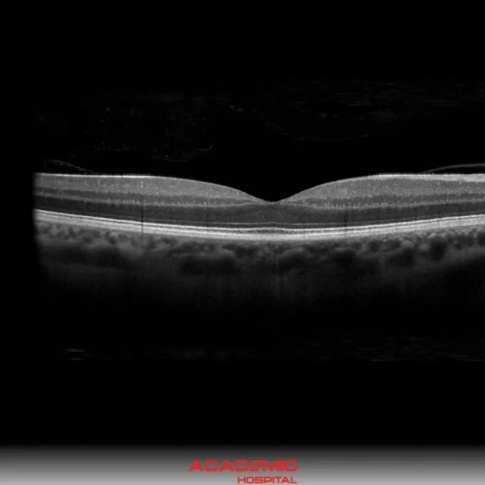 OCT (Optik Koherens Tomografi) Testi Nedir? Ne İşe Yarar?