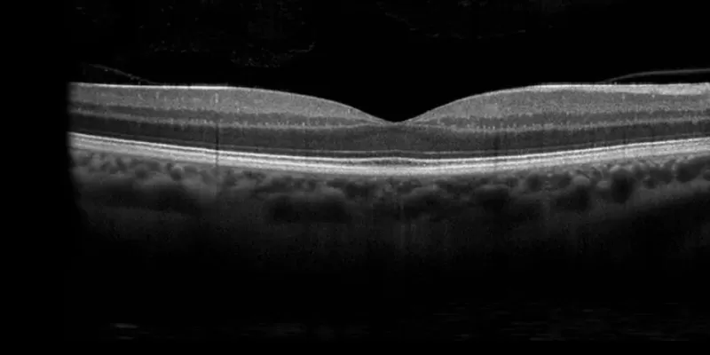 What Is an OCT (Optical Coherence Tomography) Test? What Is It Used For?