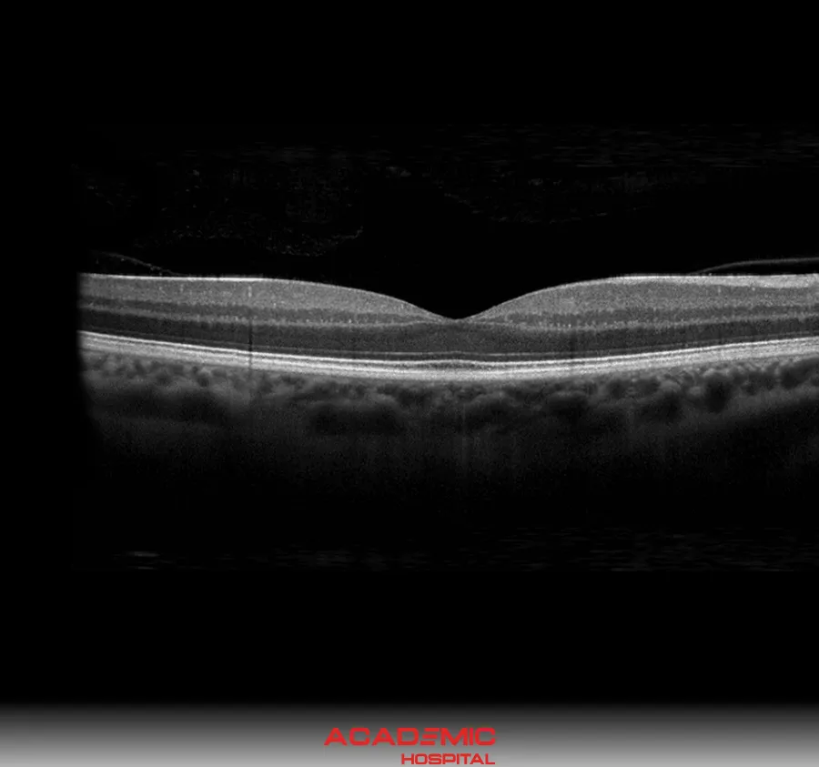 What Is an OCT (Optical Coherence Tomography) Test? What Is It Used For?
