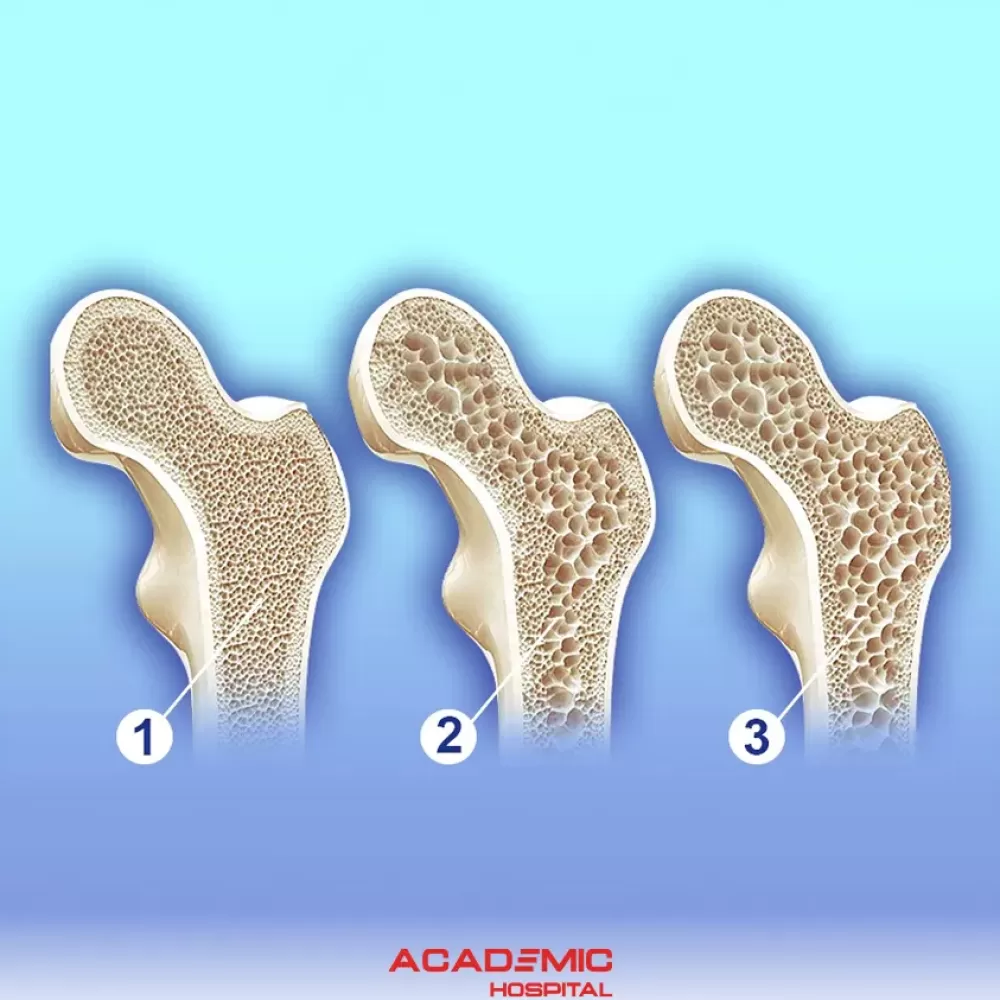 Osteoporoz Nedir? Tanı ve Tedavi Yöntemleri Nelerdir?