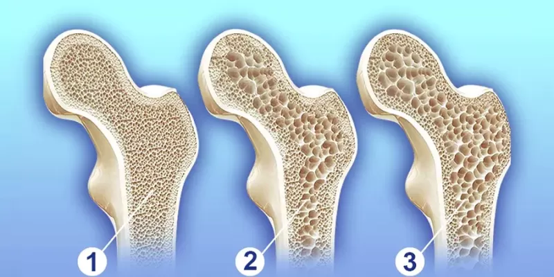 Osteoporoz Nedir? Tanı ve Tedavi Yöntemleri Nelerdir?