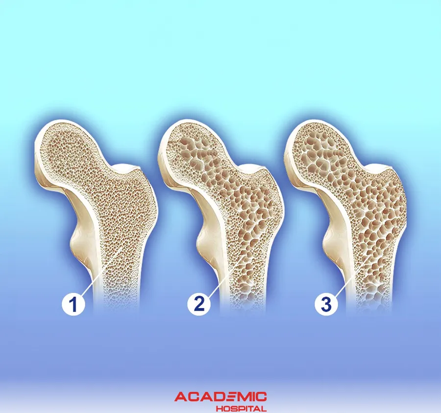 What Is Osteoporosis? What Are the Diagnostic and Treatment Methods?