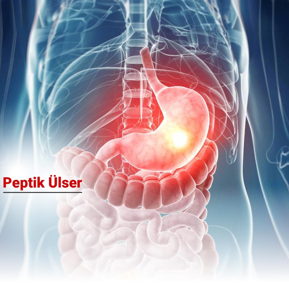 Peptik Ülser