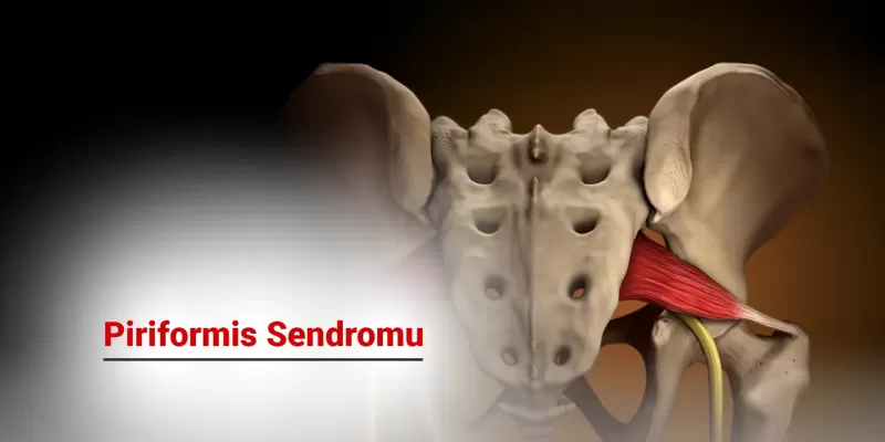Piriformis Sendromu Nedir? Belirtileri ve Tedavisi