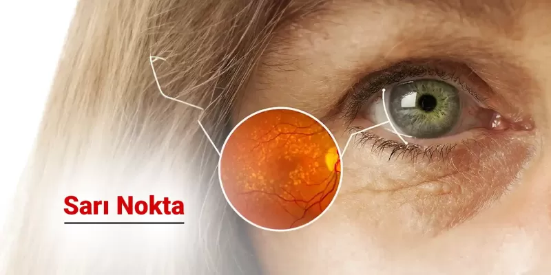 Sarı Nokta Nedir?