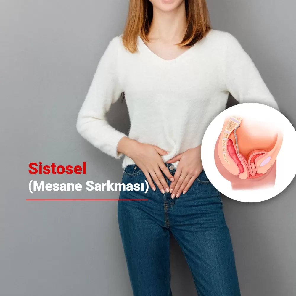 Pelvik Taban Sorunlarından Biri: Sistosel (Mesane Sarkması)