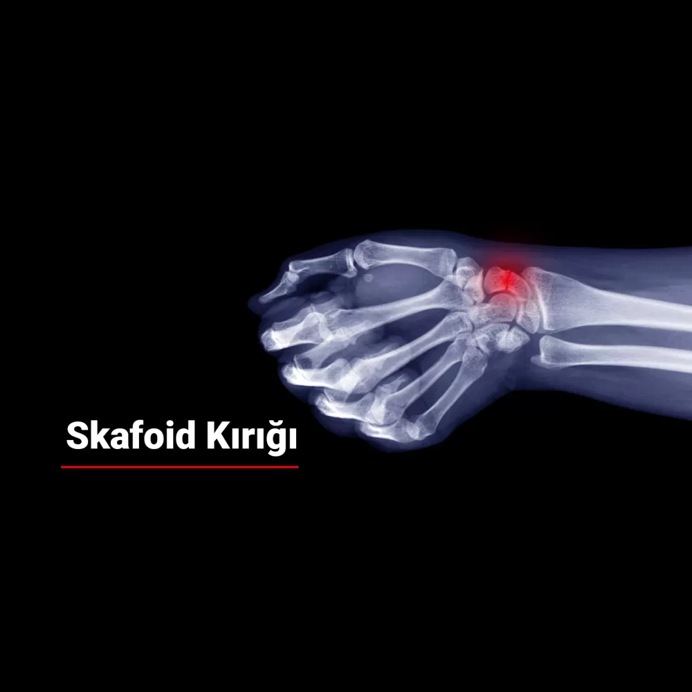 Skafoid Kırığı Nedir? Belirtileri ve Tedavisi