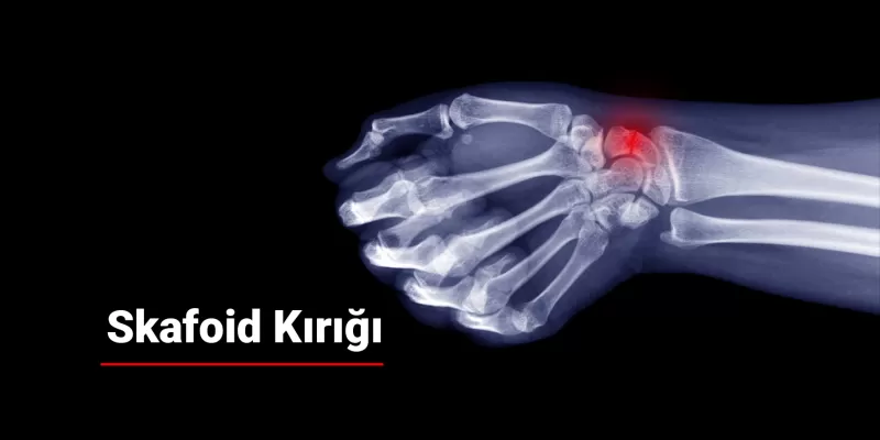 Skafoid Kırığı Nedir? Belirtileri ve Tedavisi