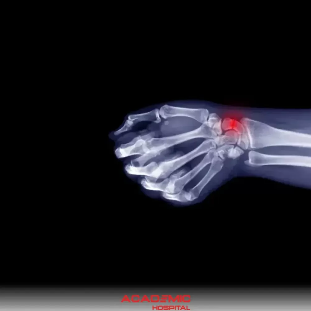 Skafoid Kırığı Nedir? Belirtileri ve Tedavisi