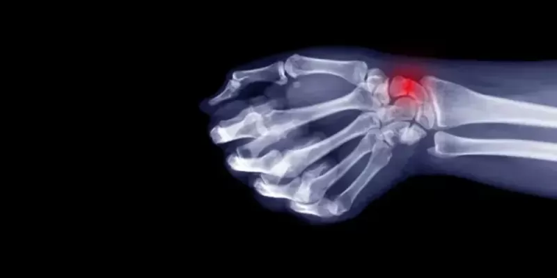 Skafoid Kırığı Nedir? Belirtileri ve Tedavisi