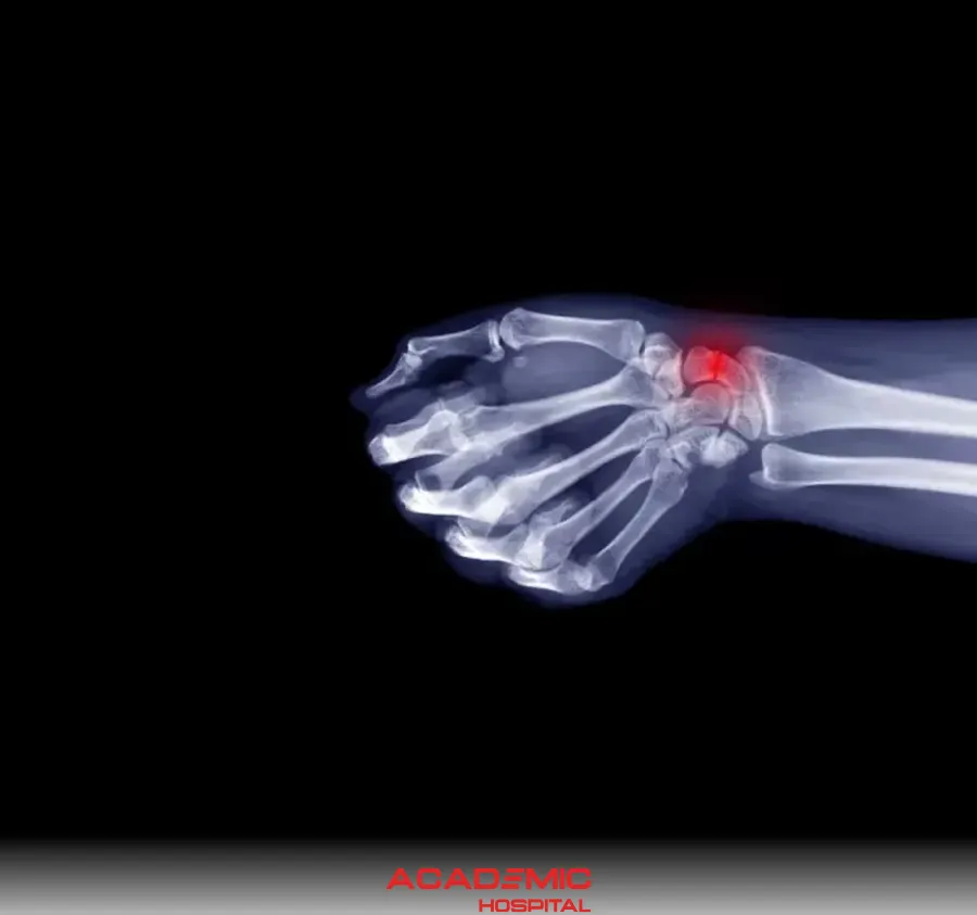 Skafoid Kırığı Nedir? Belirtileri ve Tedavisi