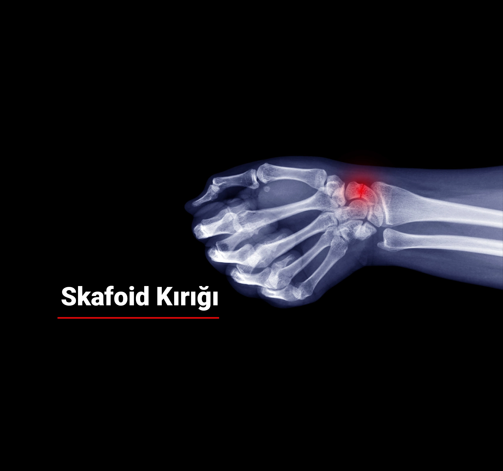 Skafoid Kırığı Nedir? Belirtileri ve Tedavisi
